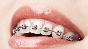 The Different Types of Braces - Westermeier Martin Dental Care